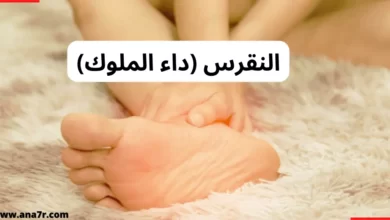 النقرس (داء الملوك)